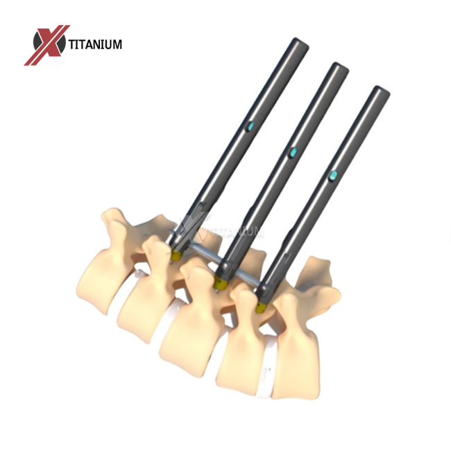 titanium rods scoliosis
